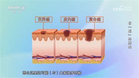 痣 凸起|身上的痣能抠吗？凸起的痣和平平的痣哪个更易恶。